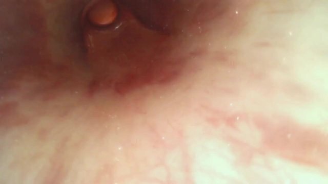 Endoscope inside tube estim urethra prostate orgasm ejaculation full length