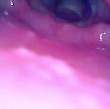 Epiglottis fabulous close view.
