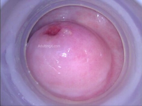 Cervix behind scenes heartbeat pulse footage Nabothian cyst