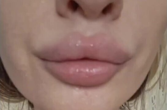 Fetish mouth with braces