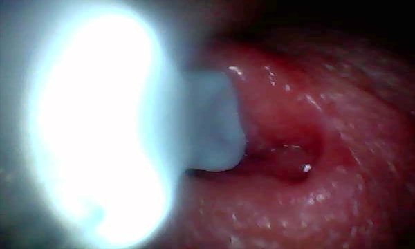 Endoscope camera captures moment male ejaculation