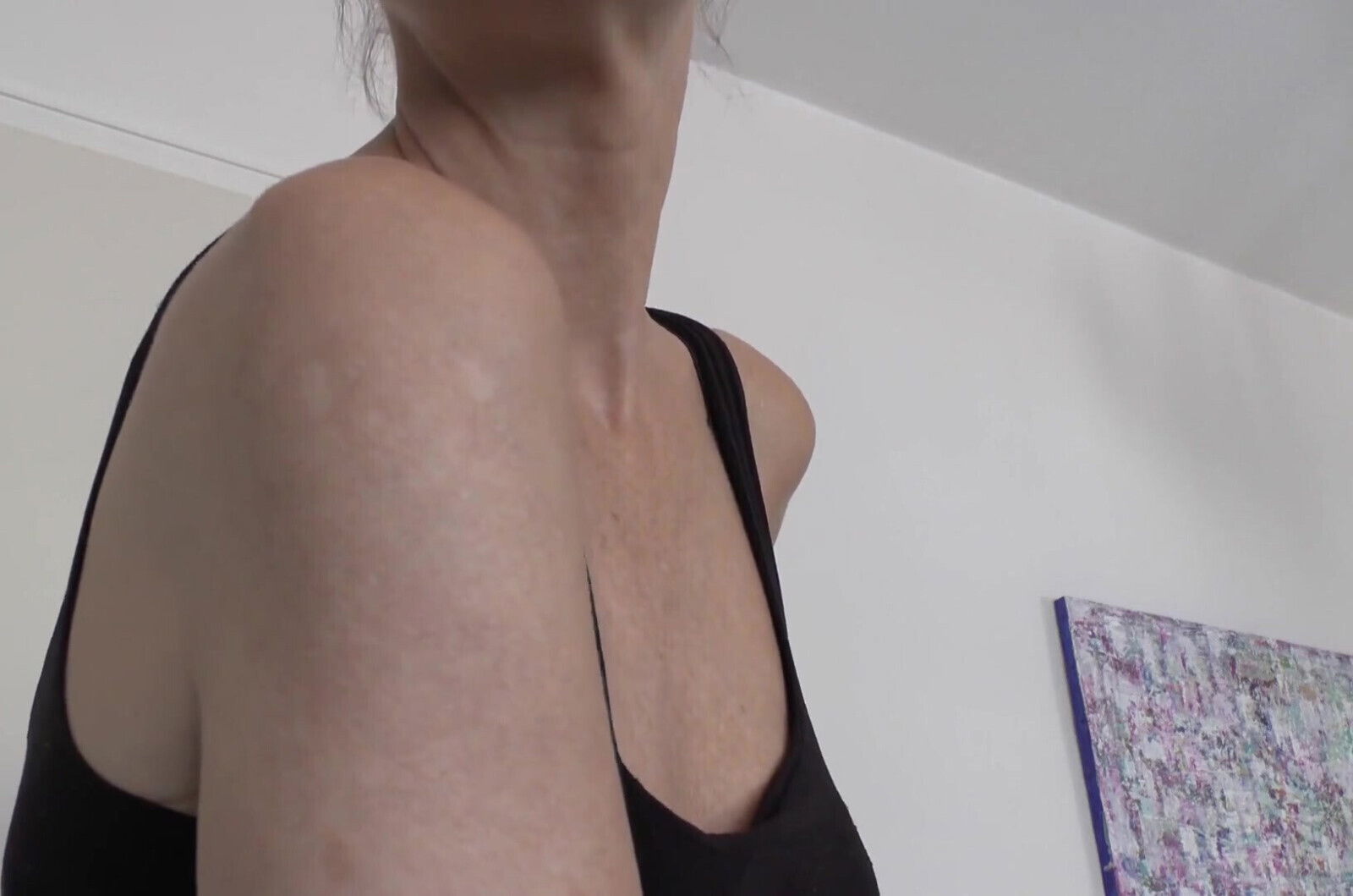 Scars Upper Arm, Lady Victoria Valente