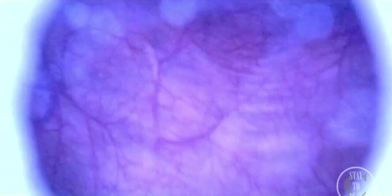 Beautiful Inside Full Bladder with Endoscope!