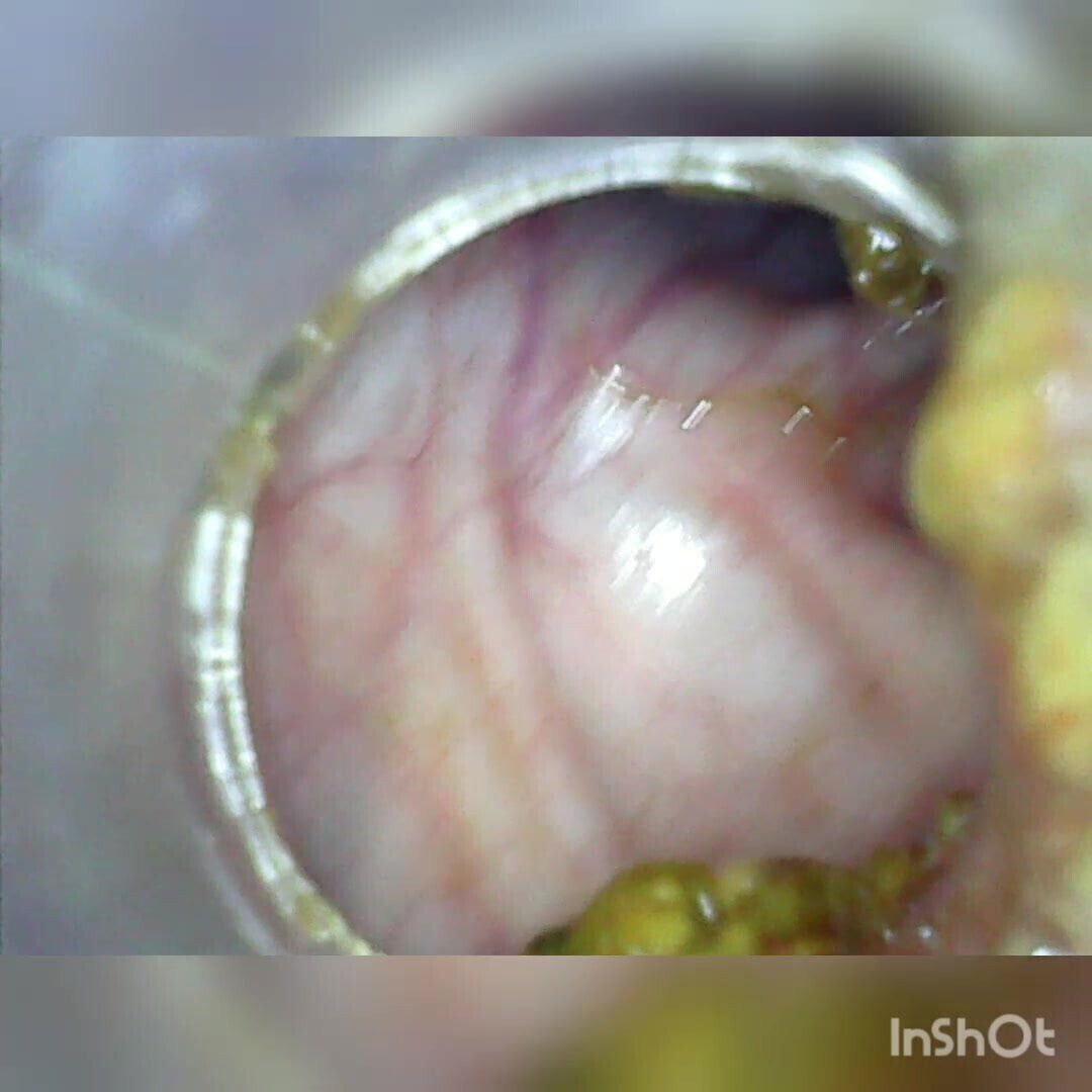 Deep deep anal again home colonoscopy Endoscope Part 1