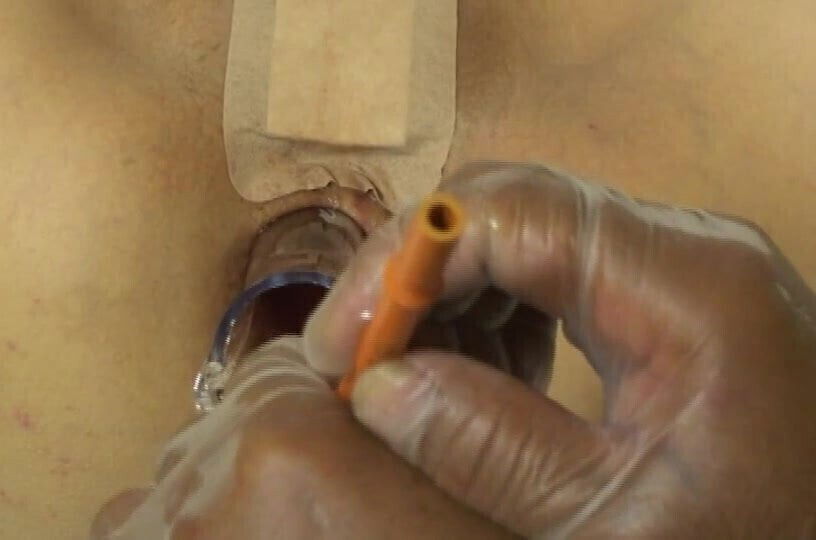 Elmer's Wife Anal fisting speculum 4