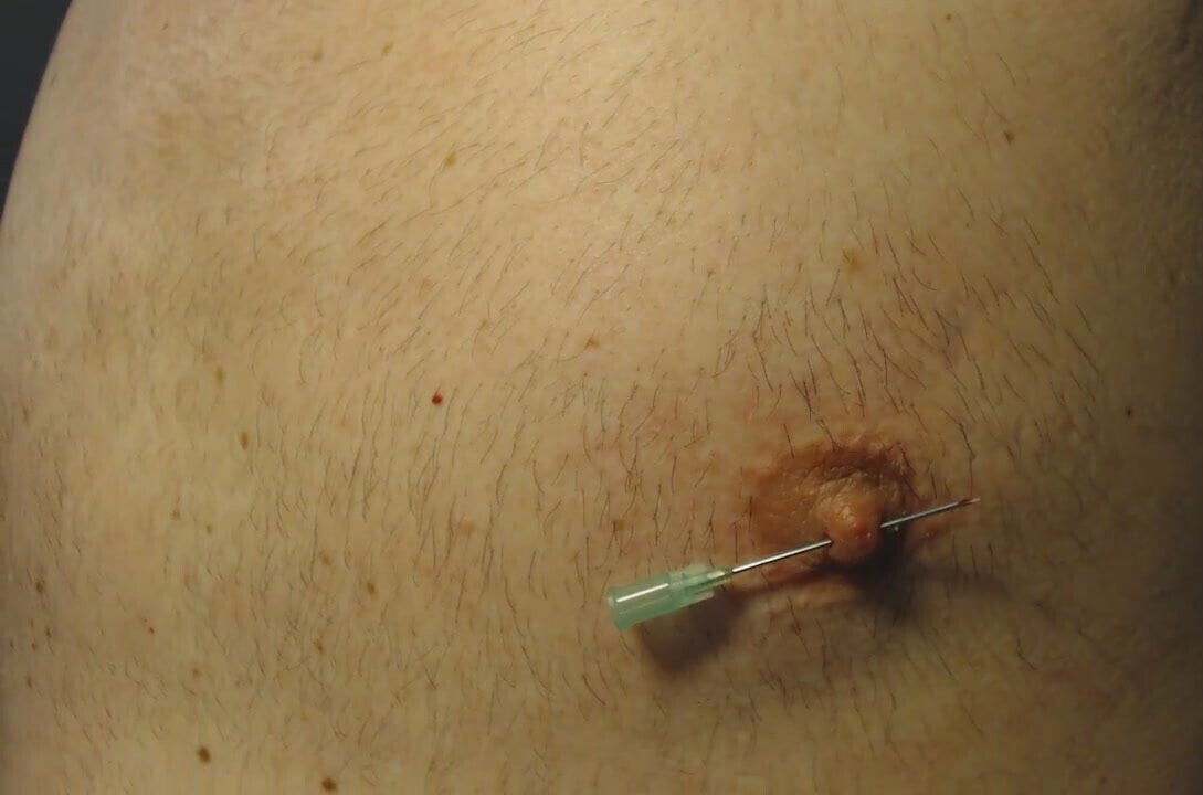 Nipple needle pain