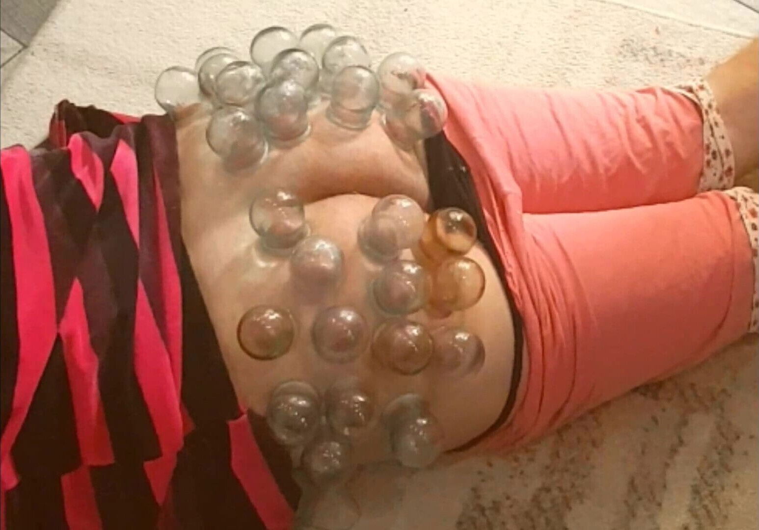 vacuum firecupping buttocks glasses