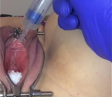 Female catheter tutorial