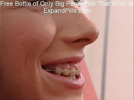 Sandra Skinny Teen Braces Facial