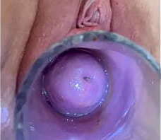Sounding cervix deeply