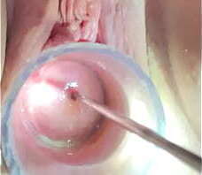 Hegar sound probing deep in cervix