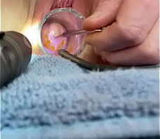 Advancing 6mm sound in cervix w cramping