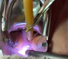 Catheterizing uterus painfully