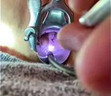 Bakes rosebud suddenly penetrates internal os painfully after gentle steady pressure