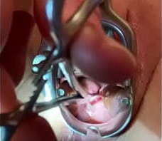 Sound tenaculum applying traction to cervix