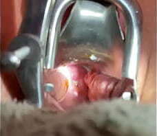 Inserting Foley into cervix