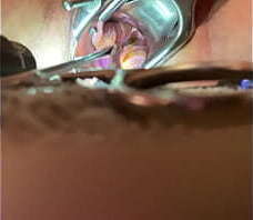 Internal view of Orgasm w sound tenaculum and vibrator