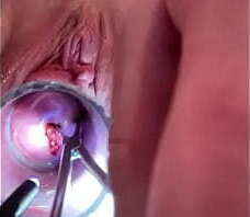 Burying the sound deeply and tightening the tenaculum so tightly