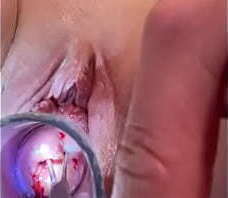 Cervix tor ture w tenaculum sounding