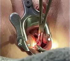 Holding cervix w tenaculum while 8mm dilator fucks uterus