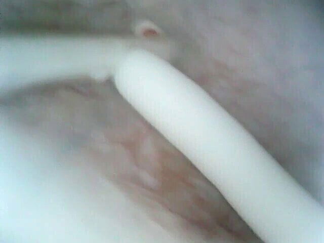 look inside bladder with endoscope inject white lube