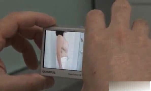 9 size of the breast - breast reduction