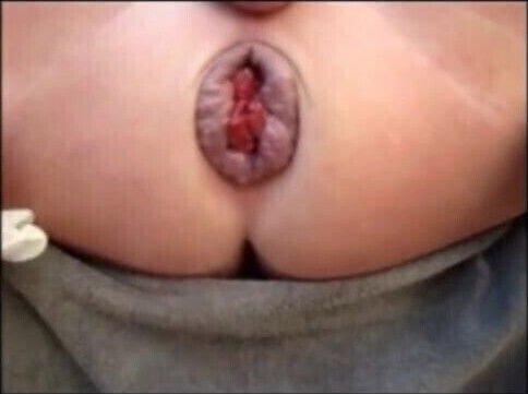 hole extrem gape