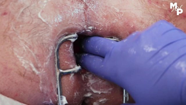 Fisten und Dehnung mit dem Spekulum. So macht Assplay Spaß