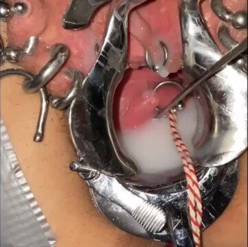 Extreme cervix sounding