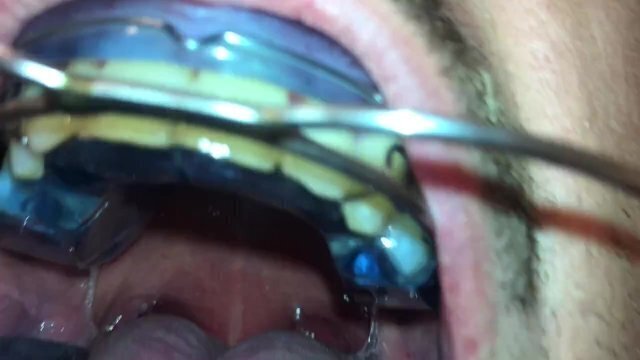 Braces retainer Twinblock with headgear aventures