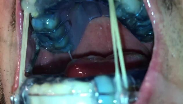 Self facial cumming braces retainer twinblock with headgear