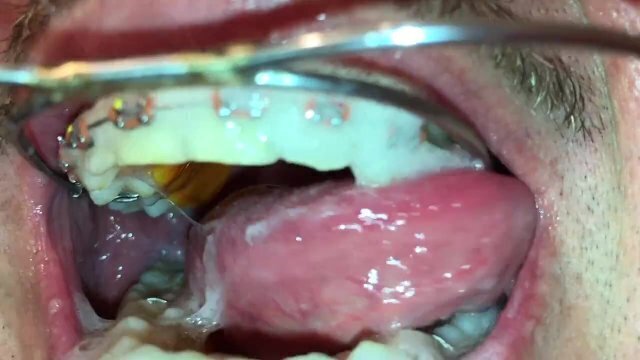 self facial braces play with