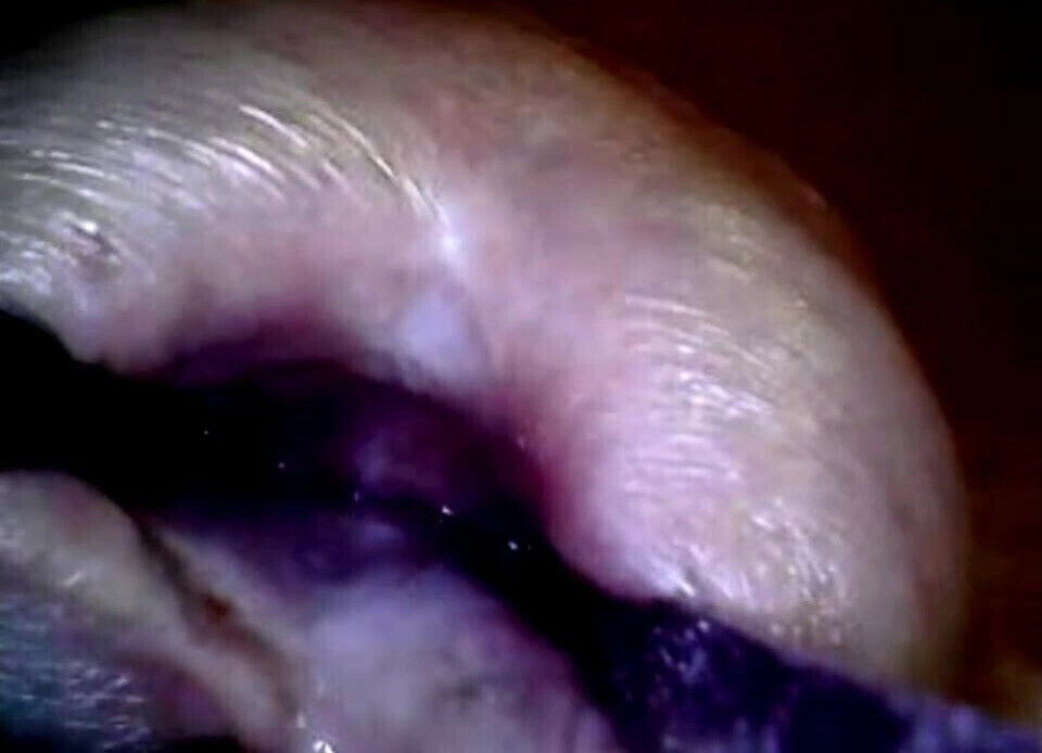 endoscope full inside urethra with ejac-inner aventure