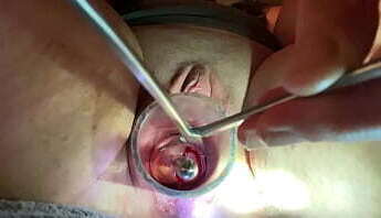 Dilating to 9mm w Tenaculum and Hegar