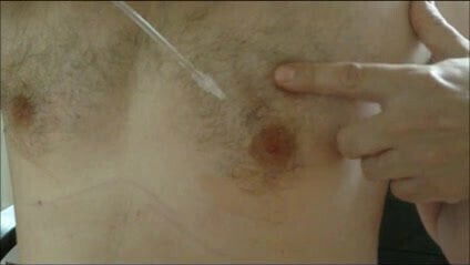 Nipples saline infusion