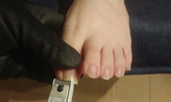 ingrown toenails care