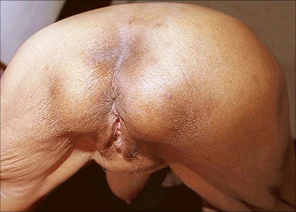 Granny asshole satyriasiss