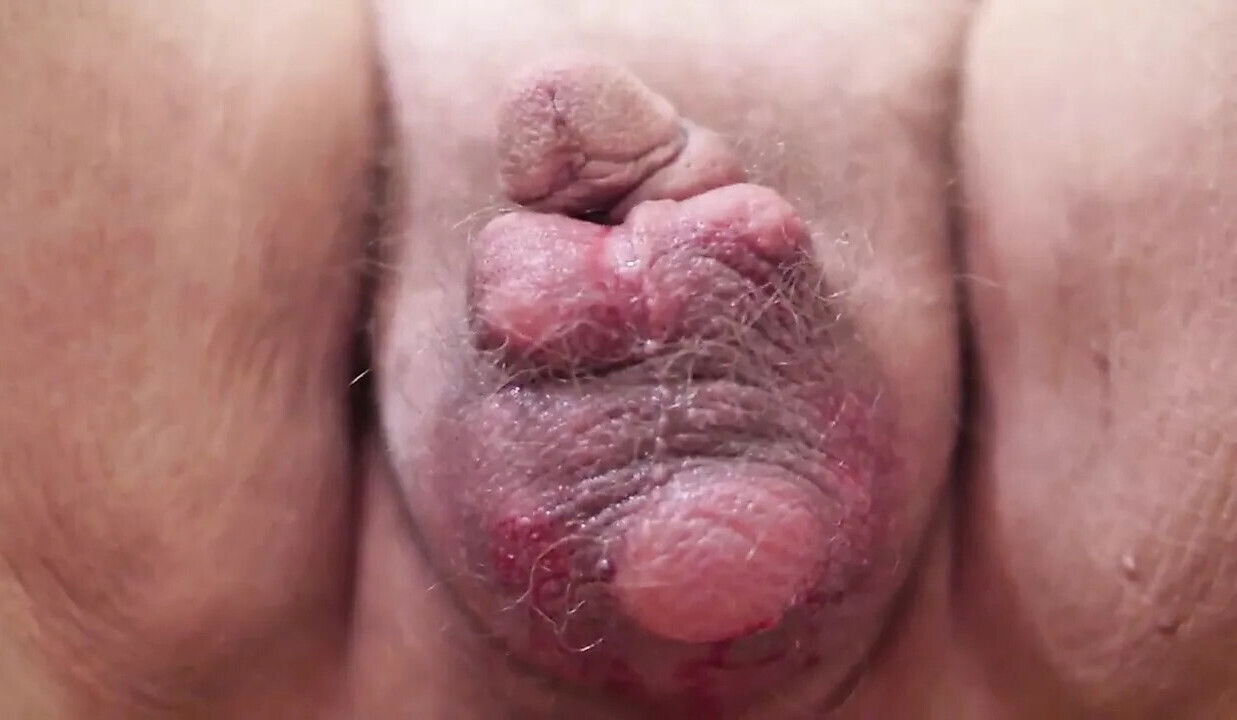 Scrotal saline inflation Mistress doctor Valeria