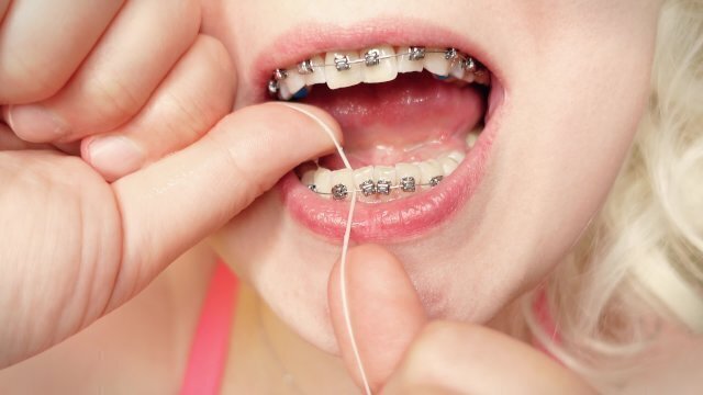 braces: cleaning dental floss