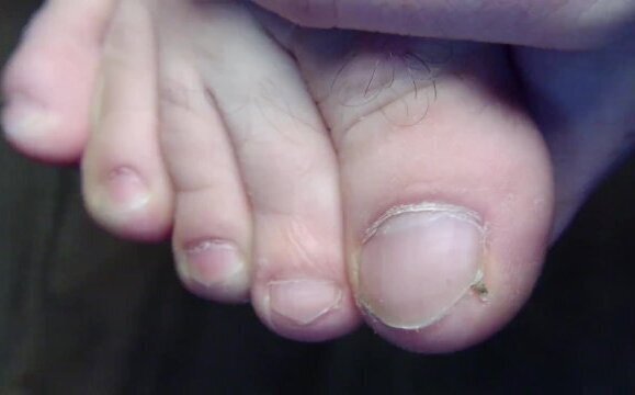 Clipping ugly toenails