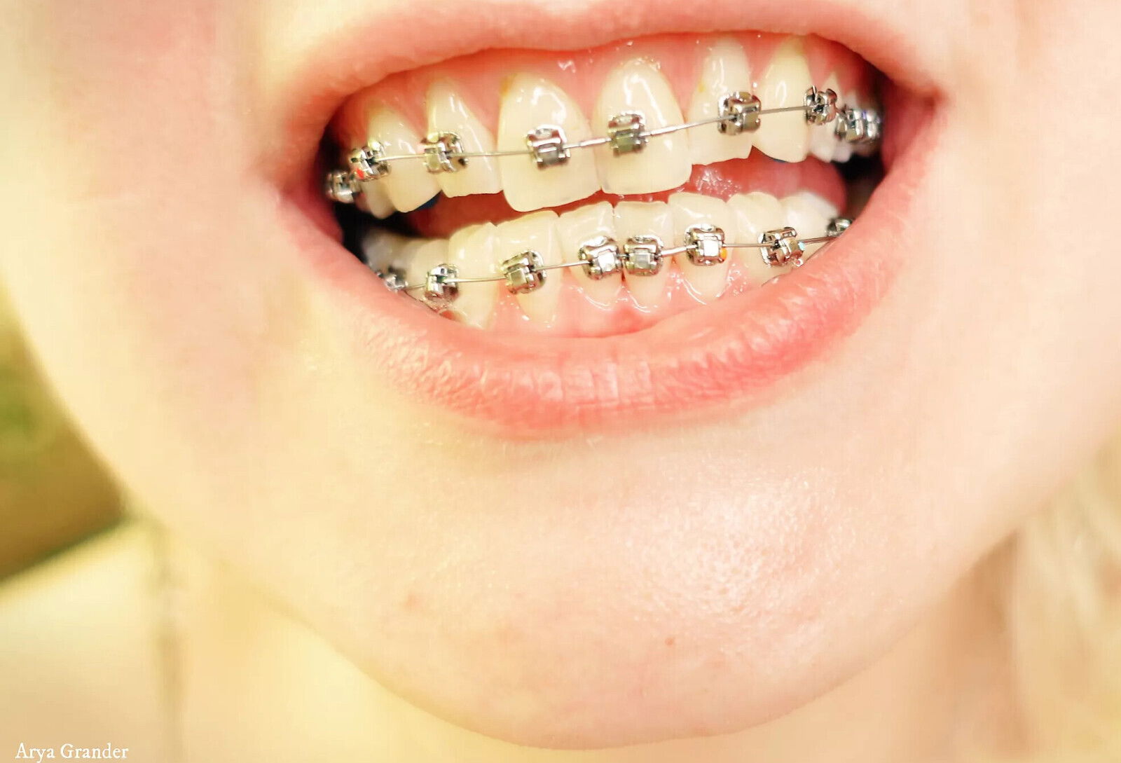 braces mouth tour video vore fetish