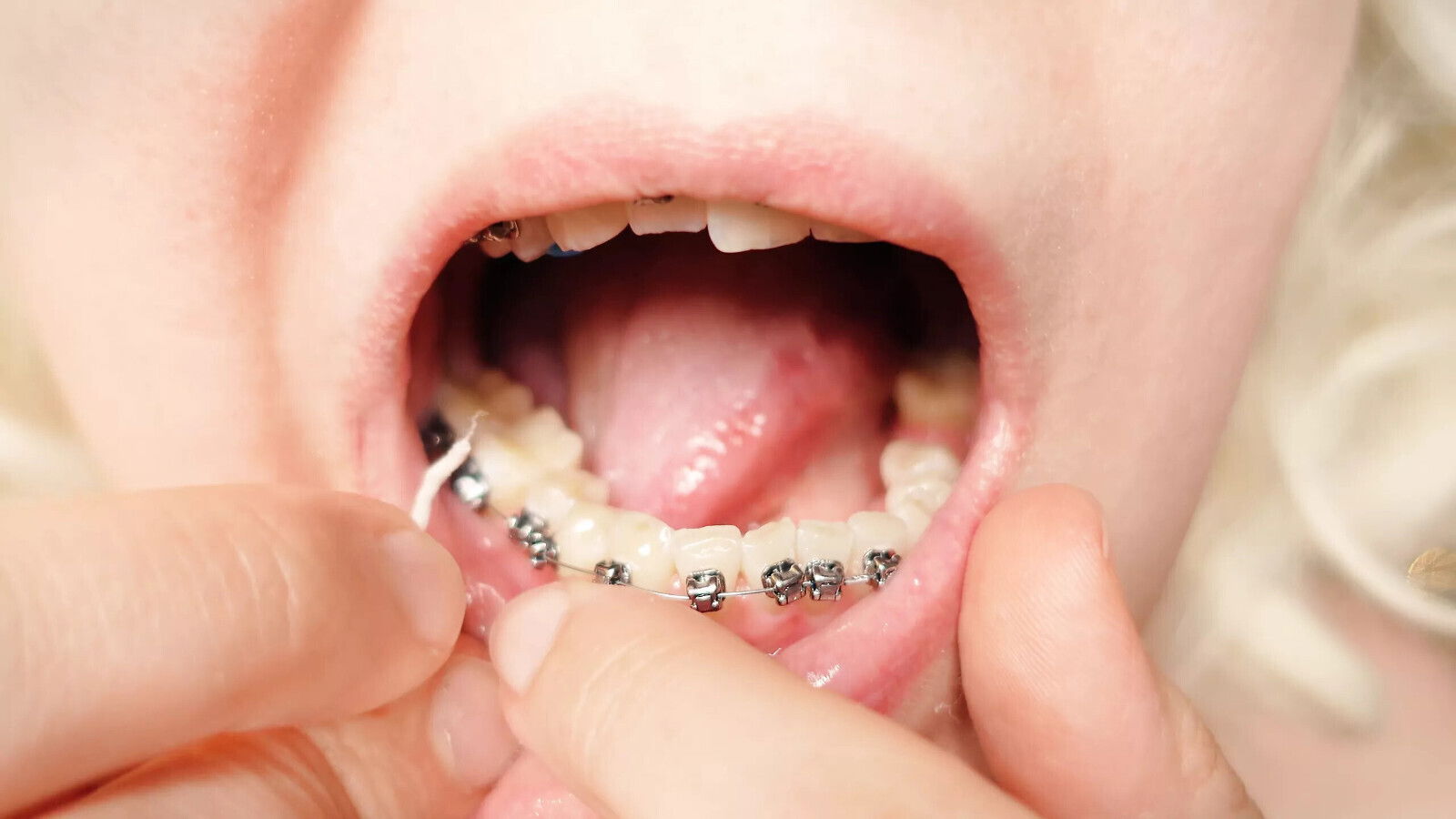 braces dental floss close mouth tour