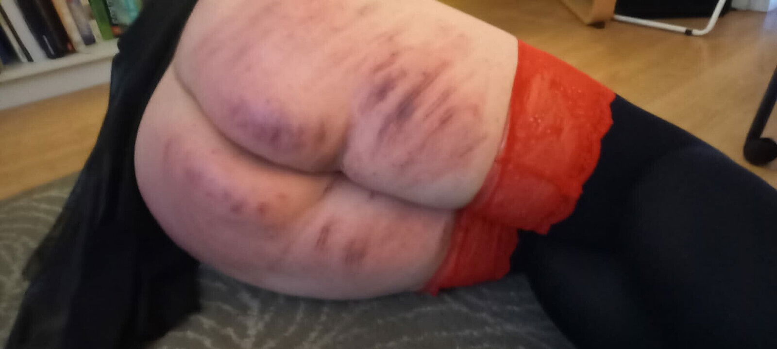 Layering bruises after caning session days