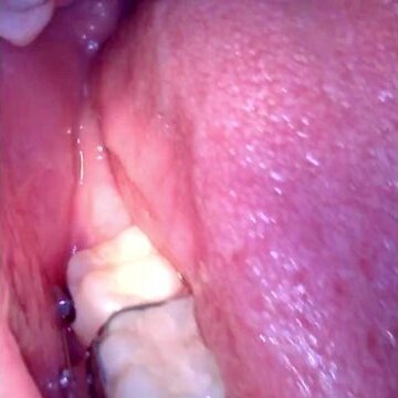 Mouth tour with braces