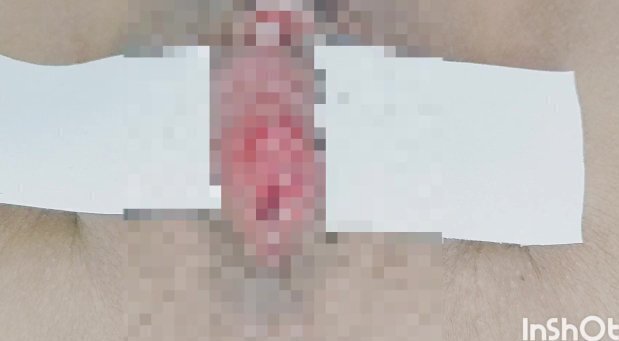 used adhesive expose clitoris.