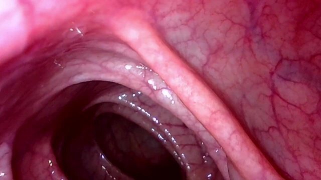 Take view peering descending colon