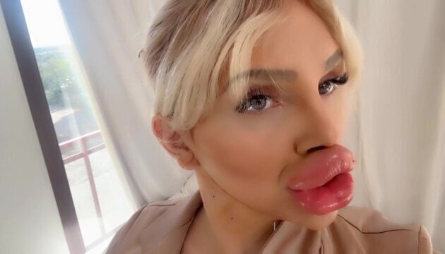 Biggest fake Lips WORLD